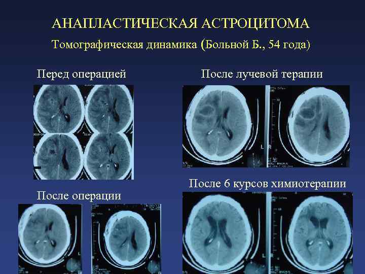 АНАПЛАСТИЧЕСКАЯ АСТРОЦИТОМА Томографическая динамика (Больной Б. , 54 года) Перед операцией После операции После