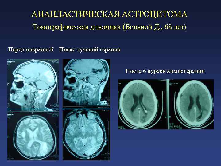 АНАПЛАСТИЧЕСКАЯ АСТРОЦИТОМА Томографическая динамика (Больной Д. , 68 лет) Перед операцией После лучевой терапии