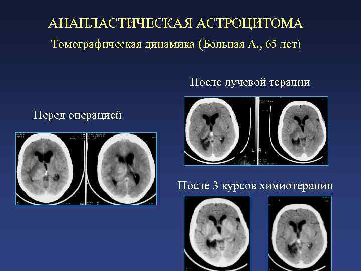 Астроцитома головного мозга прогноз. Анопластическая астроцитома. Апластическая астициома. Анапластическая астроцитома головного мозга.