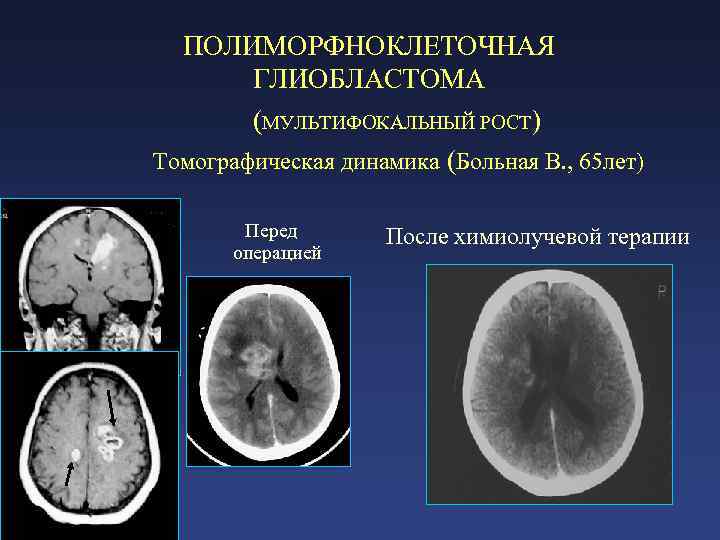 Что такое микроангиопатия головного мозга лечение