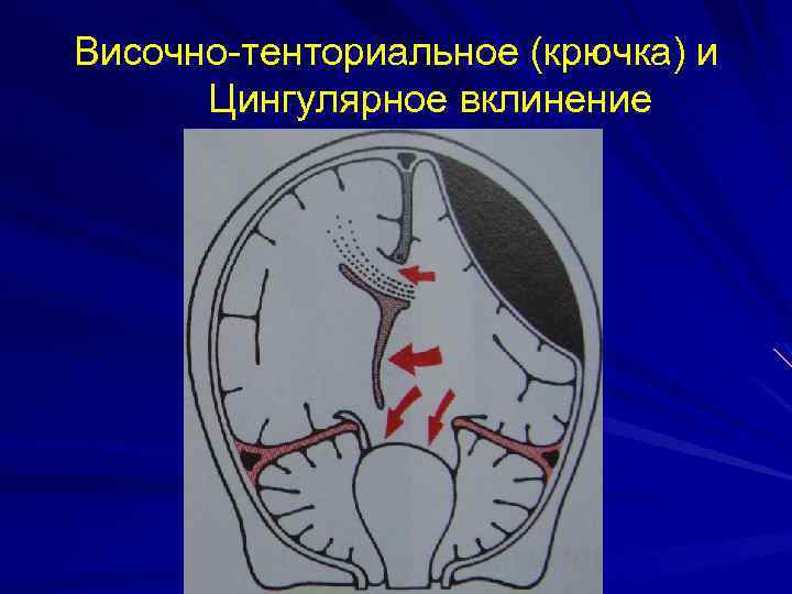Височно-тенториальное (крючка) и Цингулярное вклинение 