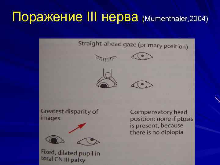 Поражение III нерва (Mumenthaler, 2004) 