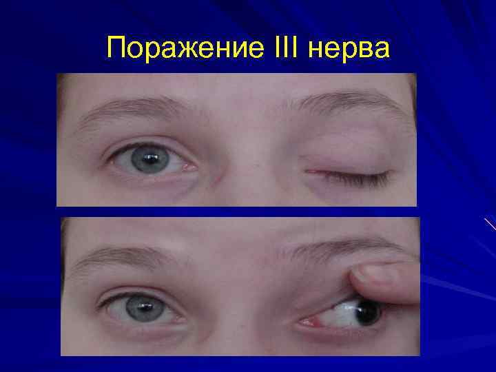 Поражение III нерва 
