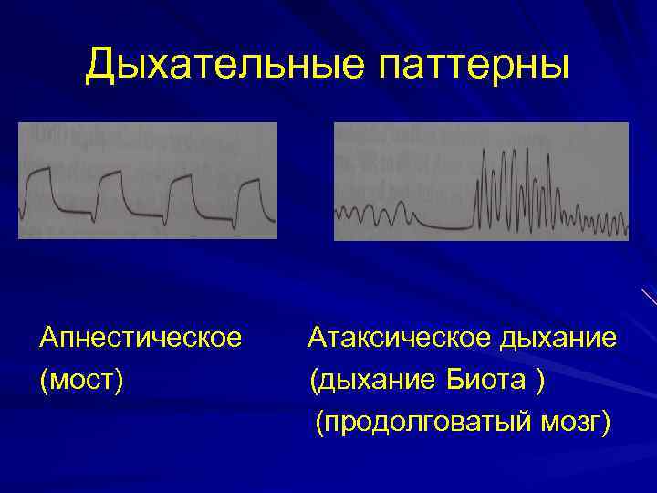 Дыхательные паттерны Апнестическое (мост) Атаксическое дыхание (дыхание Биота ) (продолговатый мозг) 
