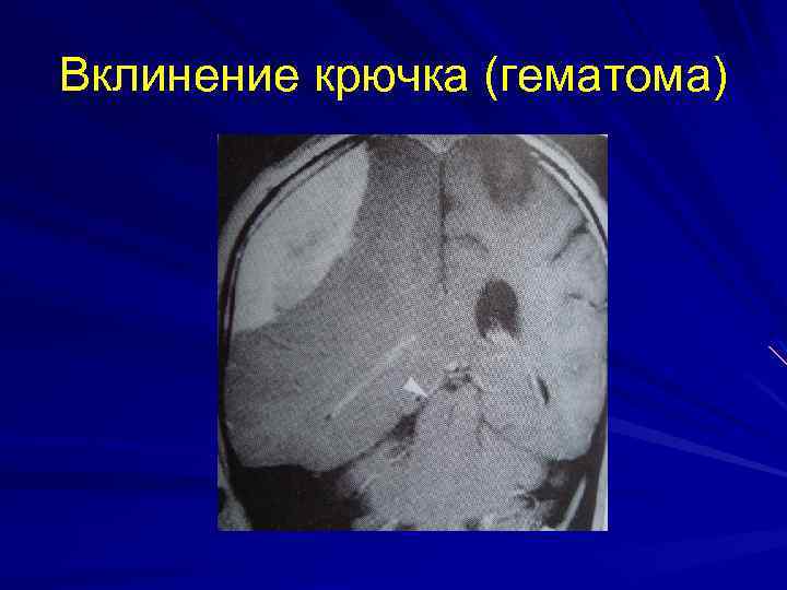 Вклинение крючка (гематома) 