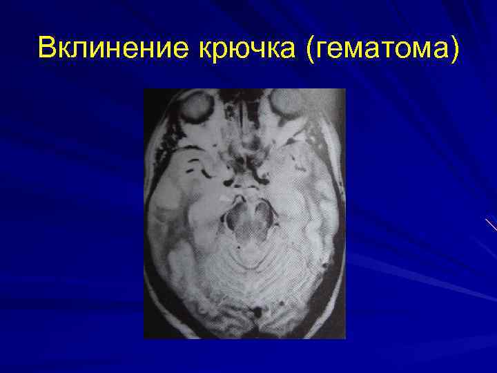 Вклинение крючка (гематома) 