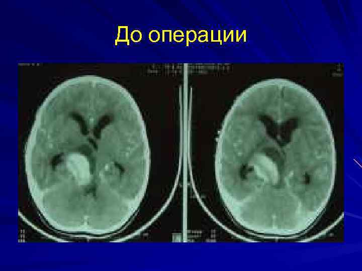 До операции 