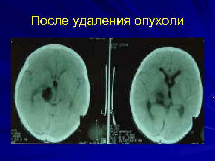 После удаления опухоли 