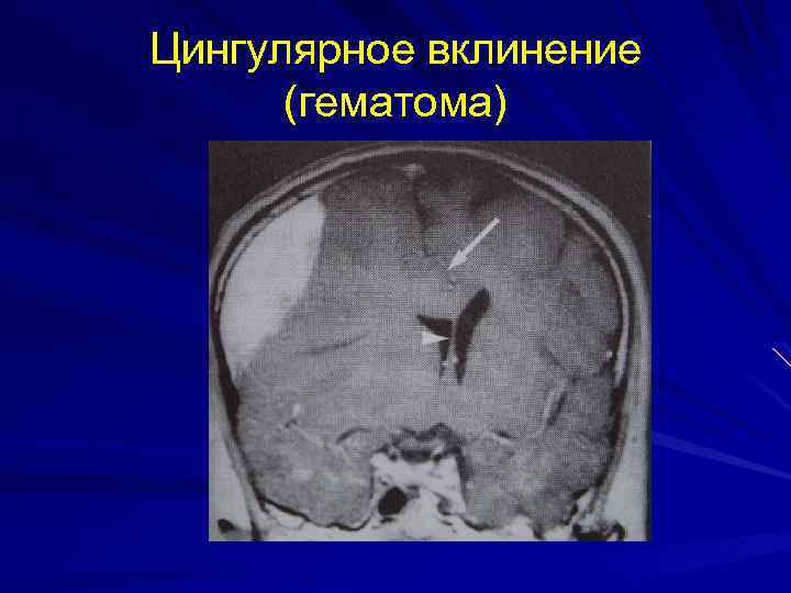 Цингулярное вклинение (гематома) 