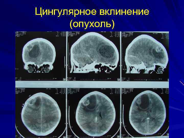 Цингулярное вклинение (опухоль) 