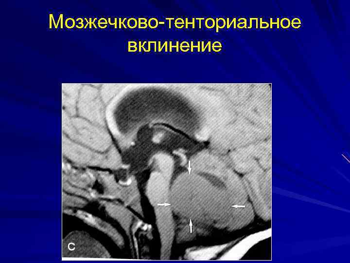 Мозжечково-тенториальное вклинение 