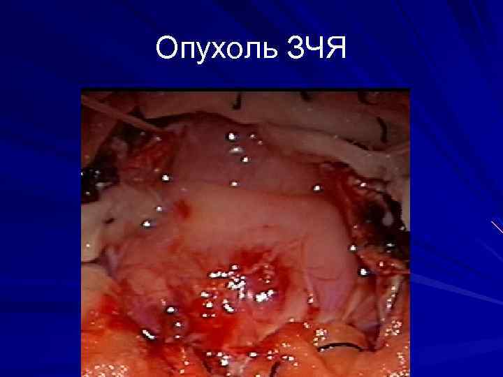 Опухоль ЗЧЯ 