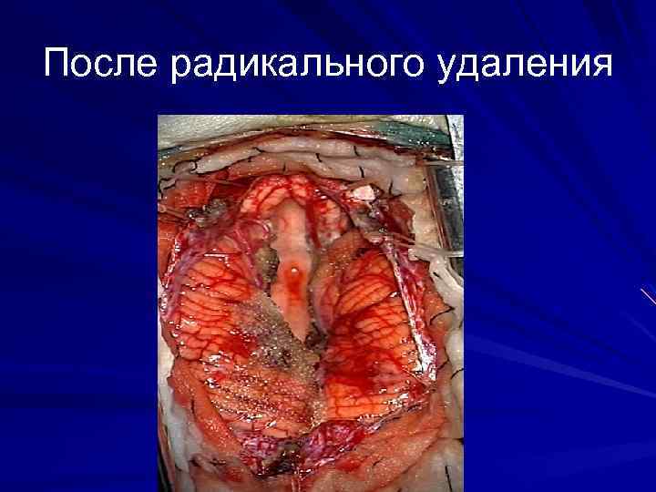 После радикального удаления 