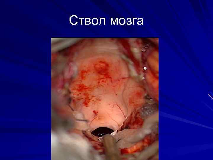 Ствол мозга 