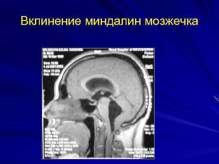 Мр картина низкого расположения миндалин мозжечка