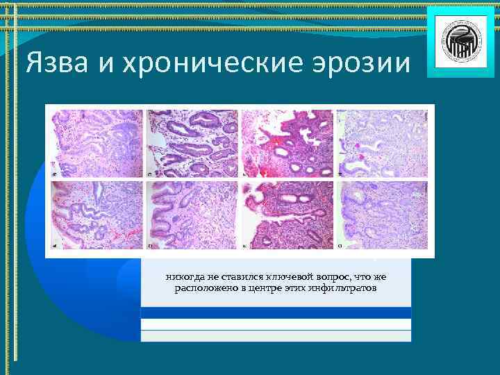 Язва и хронические эрозии представления о патогенетической связи между хроническими эрозиями и развитием ЯБ
