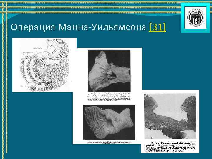 Операция Манна-Уильямсона [31] 