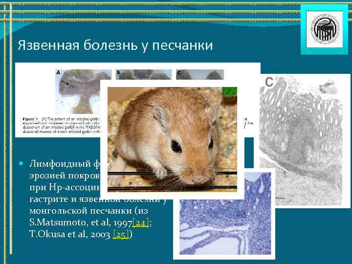 Язвенная болезнь у песчанки Лимфоидный фолликул под эрозией покровного эпителия при Hp-ассоциированном гастрите и