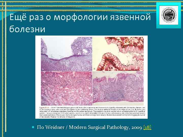Ещё раз о морфологии язвенной болезни По Weidner / Modern Surgical Pathology, 2009 [18]