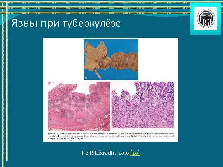 Язвы при туберкулёзе Из R. L. Kradin, 2010 [20] 