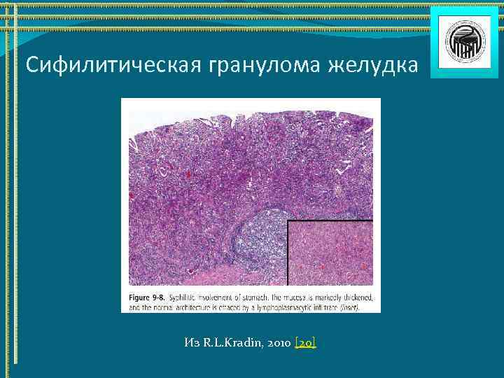 Сифилитическая гранулома желудка Из R. L. Kradin, 2010 [20] 