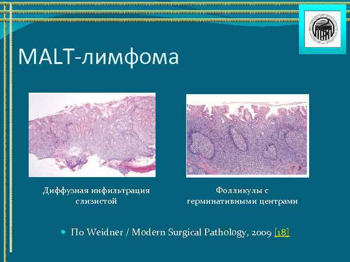 MALT-лимфома Диффузная инфильтрация слизистой Фолликулы с герминативными центрами По Weidner / Modern Surgical Pathology,