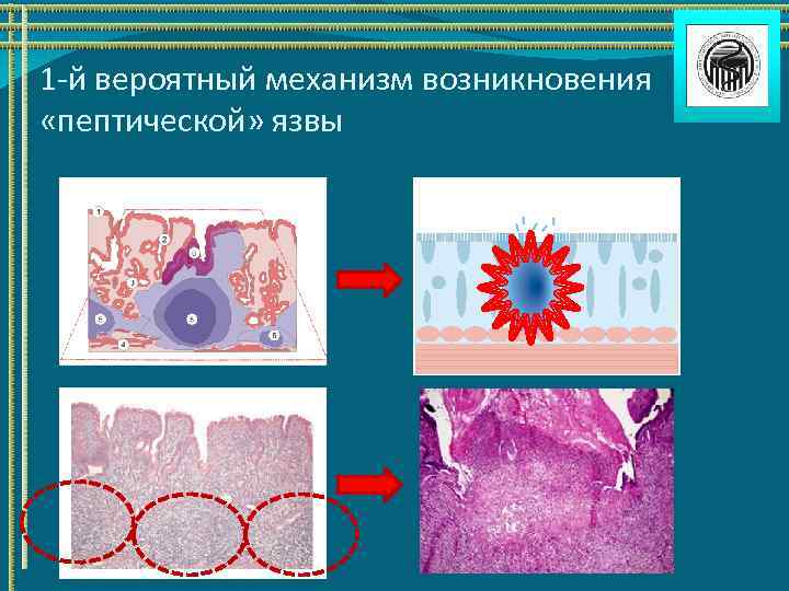 1 -й вероятный механизм возникновения «пептической» язвы 