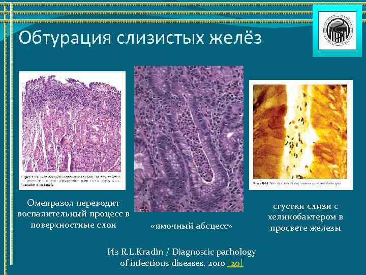 Обтурация слизистых желёз Омепразол переводит воспалительный процесс в поверхностные слои «ямочный абсцесс» Из R.