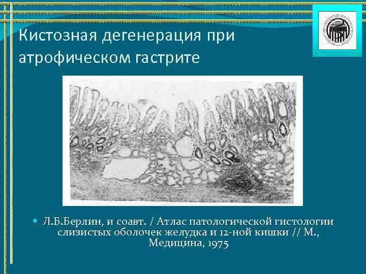 Кистозная дегенерация при атрофическом гастрите Л. Б. Берлин, и соавт. / Атлас патологической гистологии