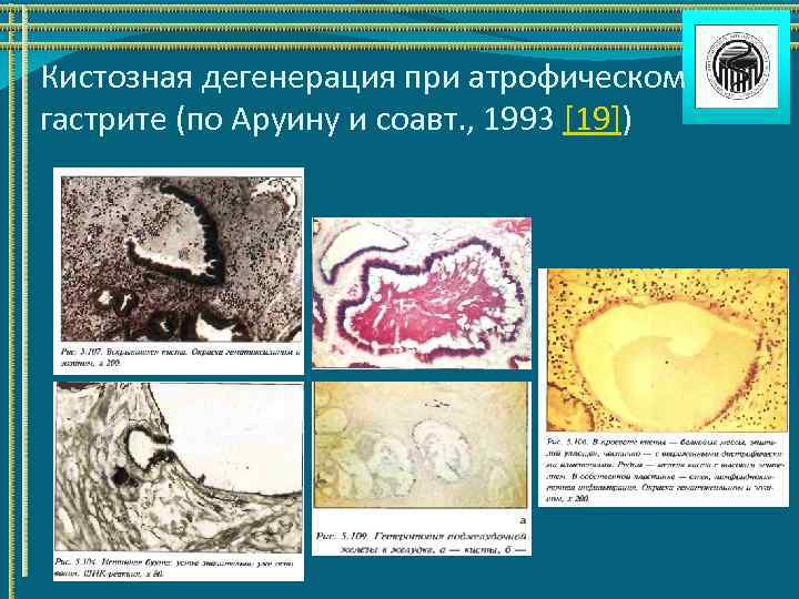 Кистозная дегенерация при атрофическом гастрите (по Аруину и соавт. , 1993 [19]) 