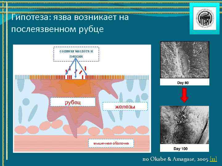 Гипотеза: язва возникает на послеязвенном рубце соляная кислота и пепсин рубец железы мышечная оболочка