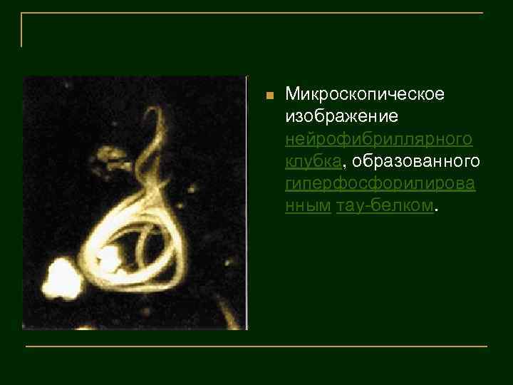 n Микроскопическое изображение нейрофибриллярного клубка, образованного гиперфосфорилирова нным тау-белком. 