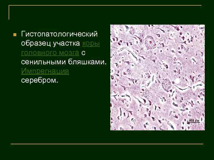 n Гистопатологический образец участка коры головного мозга с сенильными бляшками. Импрегнация серебром. 