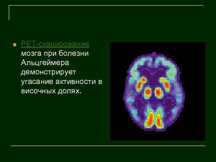 n PET-сканирование мозга при болезни Альцгеймера демонстрирует угасание активности в височных долях. 