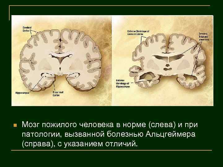 n Мозг пожилого человека в норме (слева) и при патологии, вызванной болезнью Альцгеймера (справа),