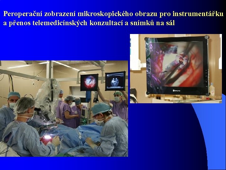 Peroperační zobrazení mikroskopického obrazu pro instrumentářku a přenos telemedicínských konzultací a snímků na sál