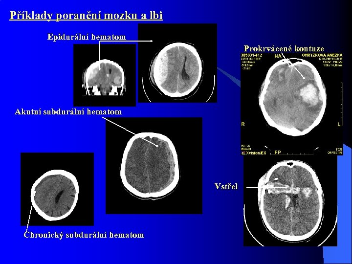 Příklady poranění mozku a lbi Epidurální hematom Prokrvácené kontuze Akutní subdurální hematom Vstřel Chronický