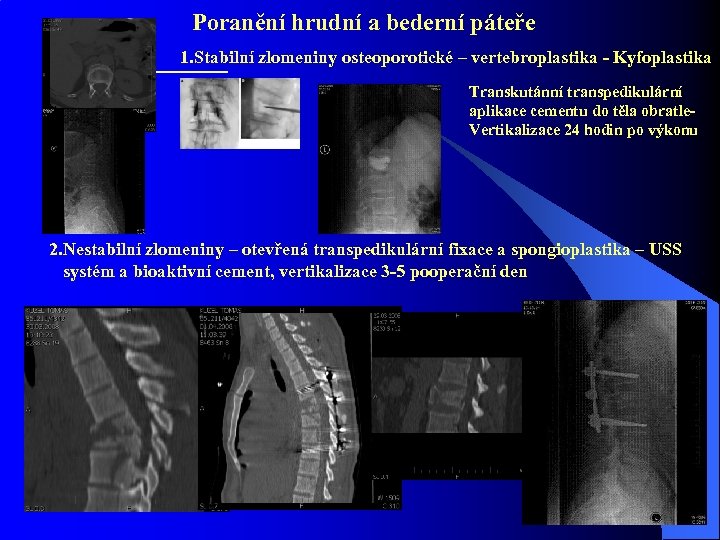 Poranění hrudní a bederní páteře 1. Stabilní zlomeniny osteoporotické – vertebroplastika - Kyfoplastika Transkutánní