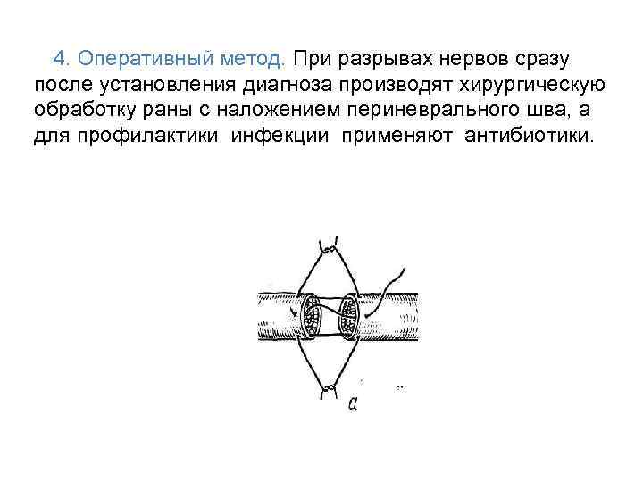 4. Оперативный метод. При разрывах нервов сразу после установления диагноза производят хирургическую обработку раны