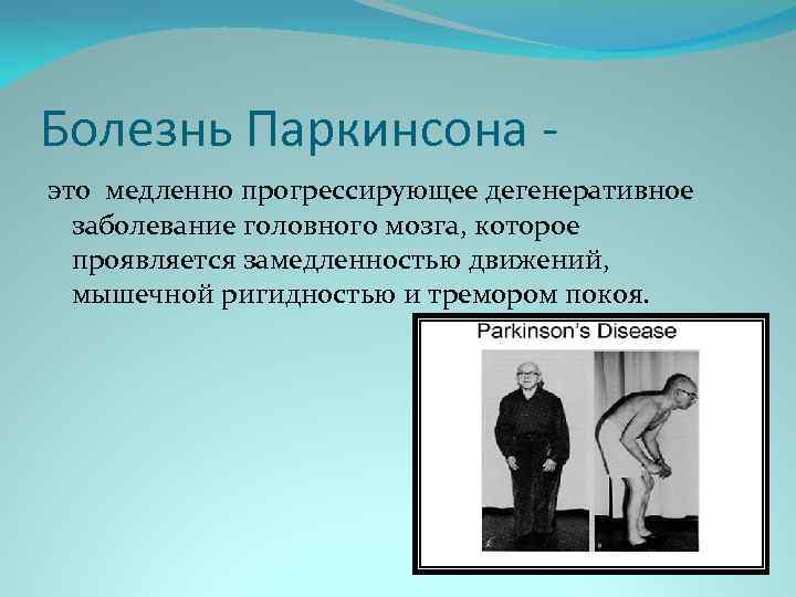 Болезнь Паркинсона это медленно прогрессирующее дегенеративное заболевание головного мозга, которое проявляется замедленностью движений, мышечной