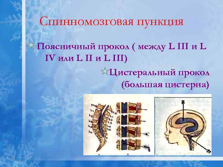 Спинномозговая пункция Поясничный прокол ( между L III и L IV или L III)
