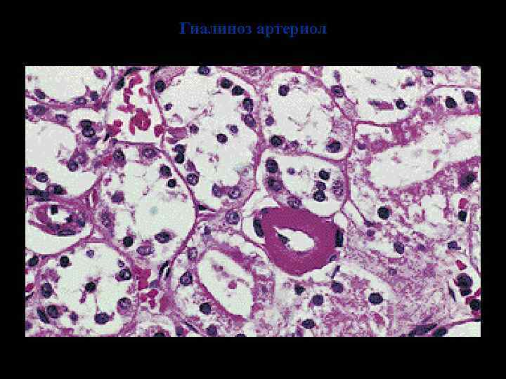 Гиалиноз артериол 