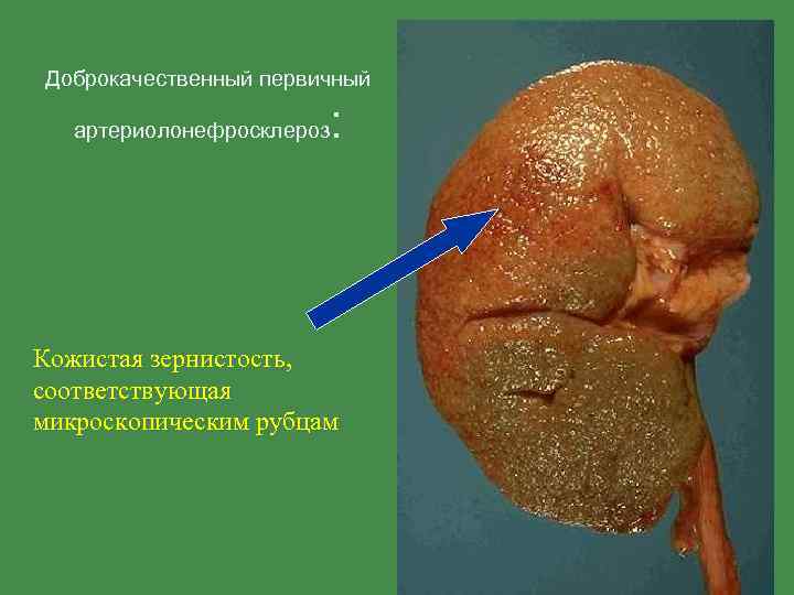 Доброкачественный первичный артериолонефросклероз : Кожистая зернистость, соответствующая микроскопическим рубцам 