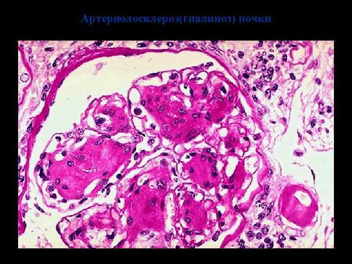 Артериолосклероз(гиалиноз) почки 