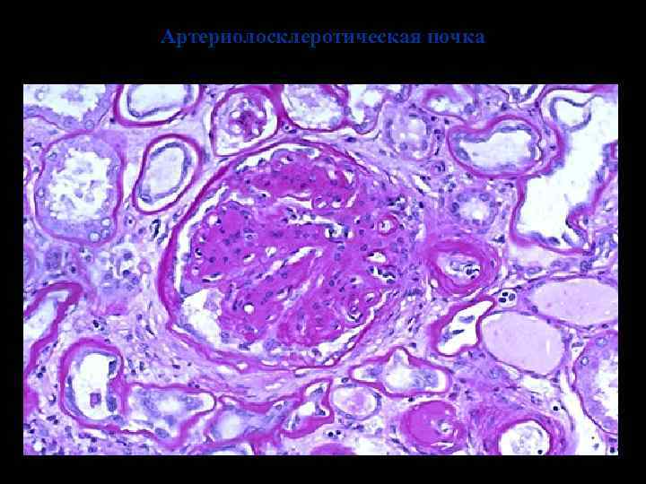 Артериолосклеротическая почка 