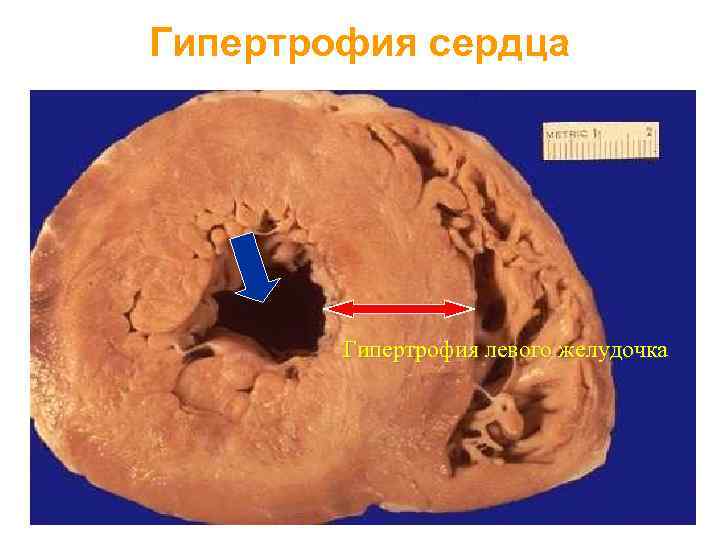 Гипертрофия сердца Гипертрофия левого желудочка 