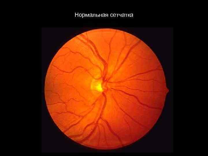 Нормальная сетчатка 