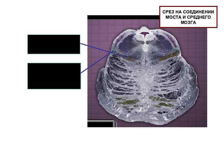 СРЕЗ НА СОЕДИНЕНИИ МОСТА И СРЕДНЕГО МОЗГА Медиальная петля Спинно-таламический тракт, спинномозговая петля 