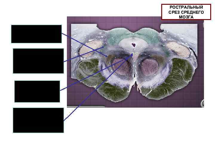 РОСТРАЛЬНЫЙ СРЕЗ СРЕДНЕГО МОЗГА Медиальная петля Спинно-таламический тракт, спинномозговая петля Ядро глазодвигательного нерва Добавочное