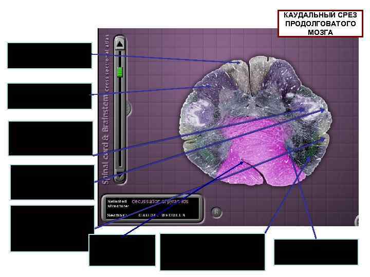 КАУДАЛЬНЫЙ СРЕЗ ПРОДОЛГОВАТОГО МОЗГА Тонкий пучок Клиновидный пучок Спинномозговое ядро тройничного нерва Спинномозговой путь